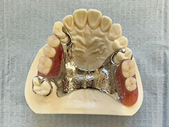 コバルト床義歯