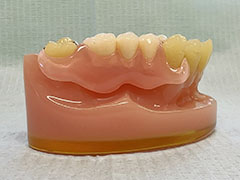 クラスプレス義歯